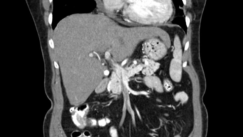 File:Adenomyomatosis of the gallbladder (Radiopaedia 12142-12483 Coronal C+ arterial phase 17).jpg