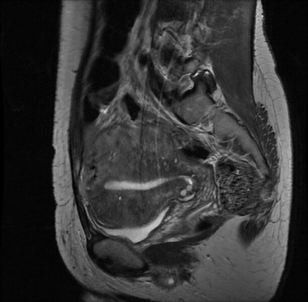 File:Adenomyosis on MRI (Radiopaedia 29328-29780 Sagittal T2 12).jpg
