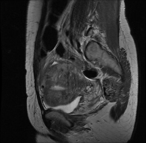 File:Adenomyosis on MRI (Radiopaedia 29328-29780 Sagittal T2 13).jpg