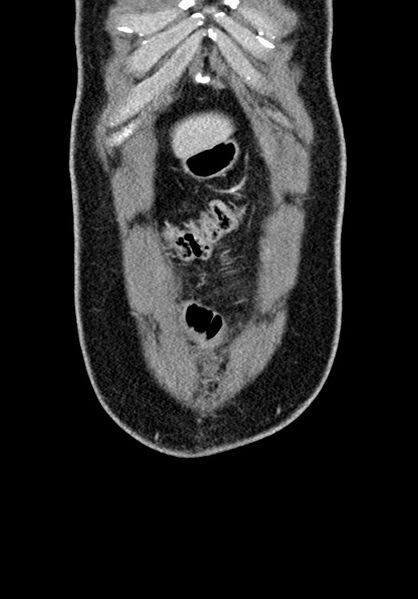 File:Adhesional small bowel obstruction (Radiopaedia 58900-66131 Coronal C+ portal venous phase 63).jpg