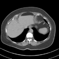 Adrenal hemangioma (Radiopaedia 33078-34103 Axial non-contrast 6).png