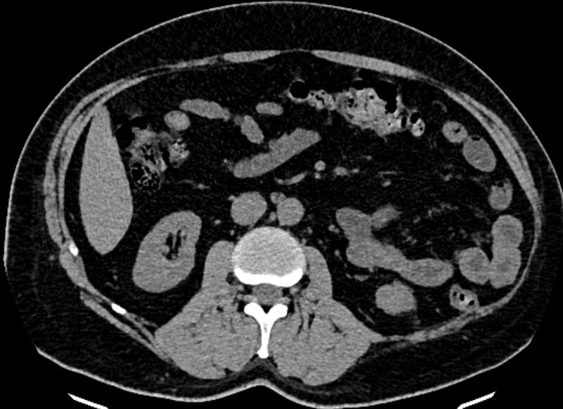 File:Adrenal metastases (Radiopaedia 73082-83791 Axial non-contrast 90).jpg