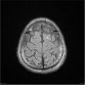 Amnestic syndrome secondary to hypoxic brain injury (Radiopaedia 24743-25004 FLAIR 19).jpg