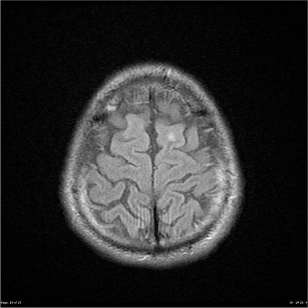 File:Amnestic syndrome secondary to hypoxic brain injury (Radiopaedia 24743-25004 FLAIR 19).jpg