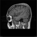 Amnestic syndrome secondary to hypoxic brain injury (Radiopaedia 24743-25004 T1 3).jpg