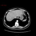 Ampullary carcinoma (Radiopaedia 56396-63056 B 14).jpg
