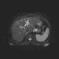 Ampullary tumor (Radiopaedia 27294-27479 T2 SPAIR 14).jpg