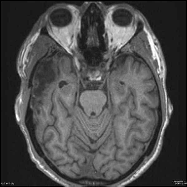 File:Anaplastic meningioma with recurrence (Radiopaedia 34452-35788 Axial T1 45).jpg