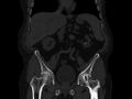 Ankylosing spondylitis (Radiopaedia 44609-48357 Coronal bone window 26).jpg
