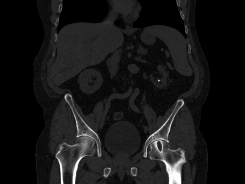 Ankylosing spondylitis (Radiopaedia 44609-48357 Coronal bone window 26).jpg