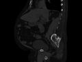 Ankylosing spondylitis (Radiopaedia 44609-48357 Sagittal bone window 41).jpg