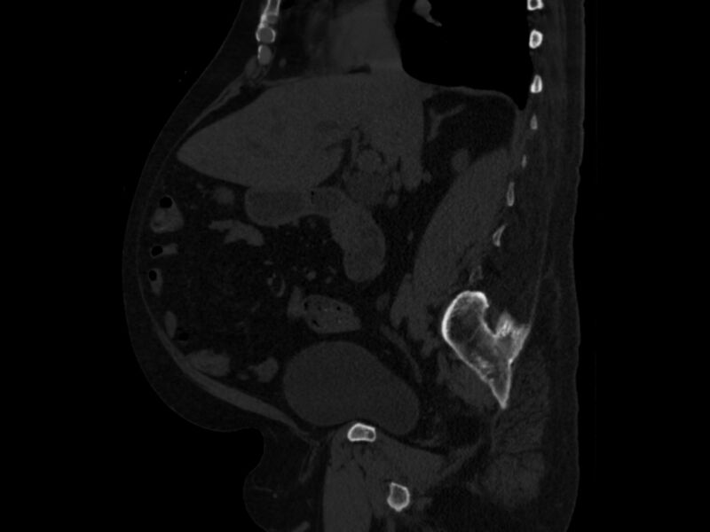 File:Ankylosing spondylitis (Radiopaedia 44609-48357 Sagittal bone window 41).jpg
