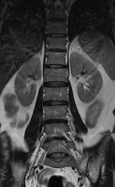 File:Ankylosing spondylitis - Andersson lesion (Radiopaedia 81878-95838 Coronal T2 7).jpg
