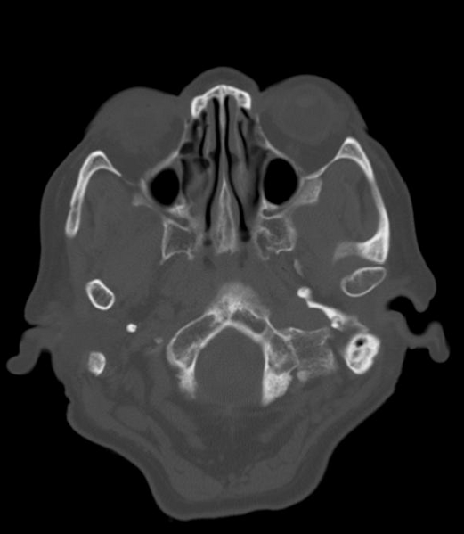 File:Anomalous intracranial venous drainage (Radiopaedia 28161-28418 Axial 17).png