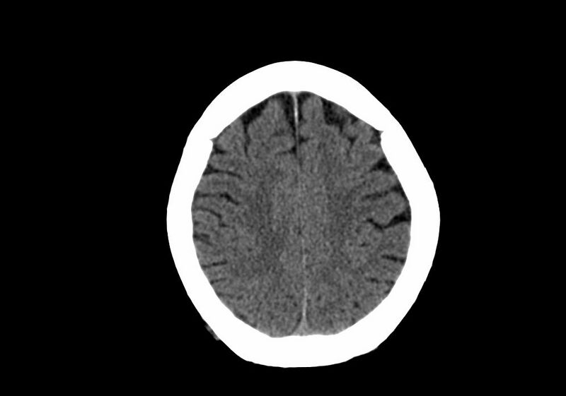 File:Anomalous intracranial venous drainage (Radiopaedia 28161-28418 Axial non-contrast 34).jpg