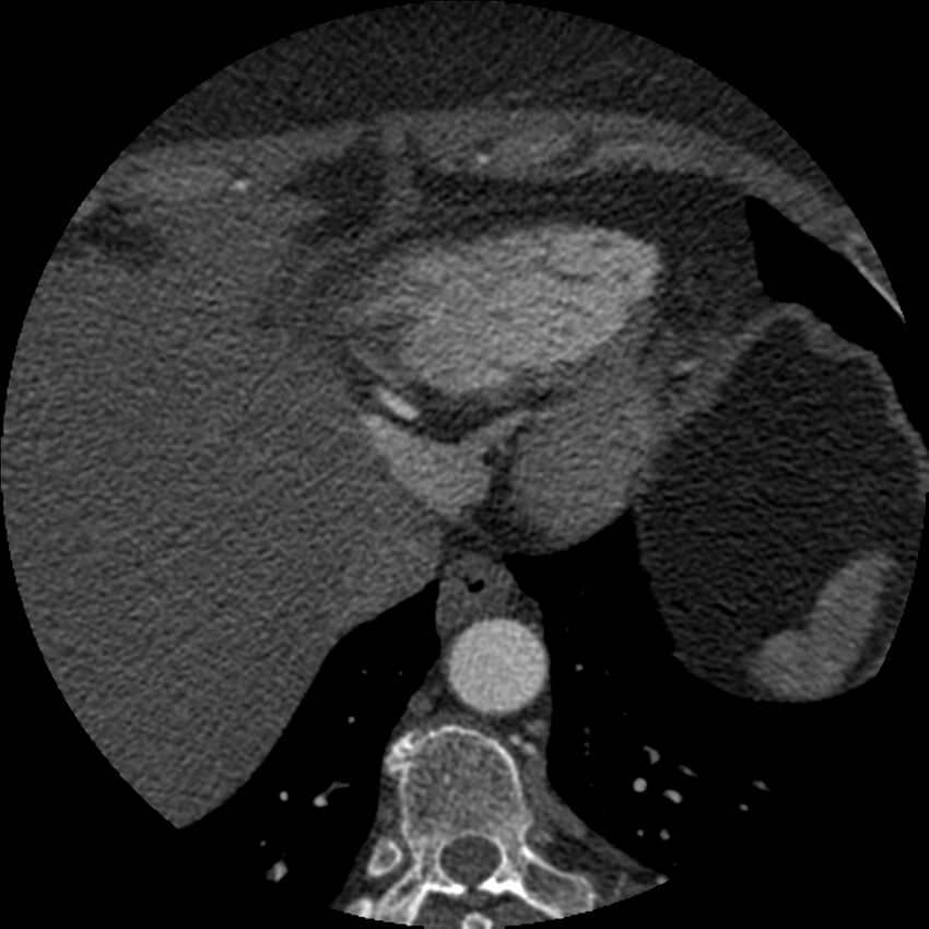 Anomalous origin of left circumflex artery from right coronary sinus (Radiopaedia 72563-83117 B 156).jpg