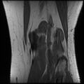 Anterior cruciate ligament tear, Wrisberg rip and bucket-handle tear of medial meniscus (Radiopaedia 75872-87266 Coronal T1 23).jpg