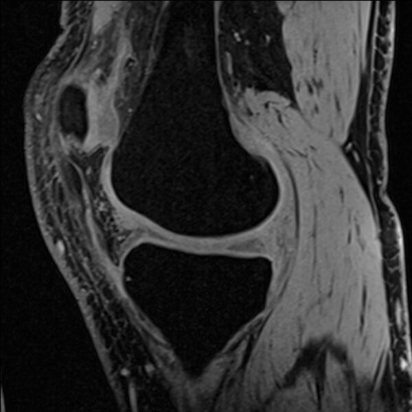 File:Anterior cruciate ligament tear - ramp lesion (Radiopaedia 71883-82322 Sagittal T1 vibe 92).jpg