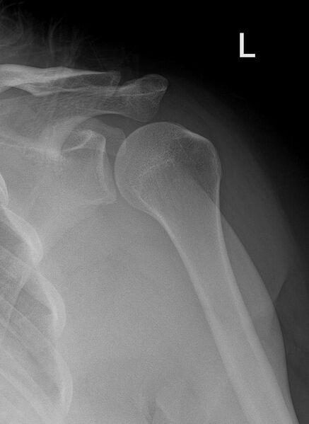 File:Anterior shoulder dislocation (Radiopaedia 55849-62435 Frontal 1).jpg