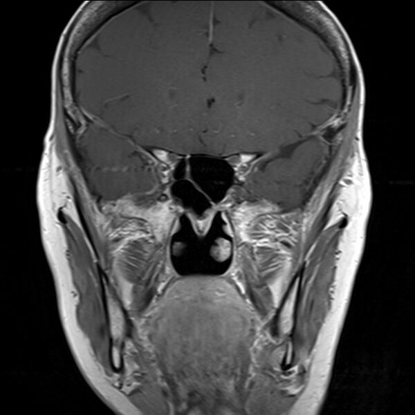 File:Anterior temporal encephalocele (Radiopaedia 82624-96808 Coronal T1 2).jpg