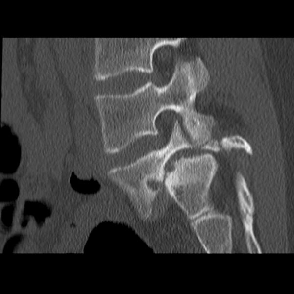 File:Anterolisthesis (Radiopaedia 22226-22263 Sagittal bone window 15).jpg