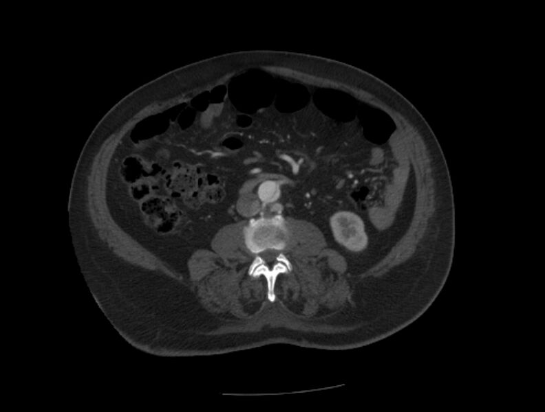 File:Aortic dissection (Radiopaedia 28802-29105 A 67).jpg