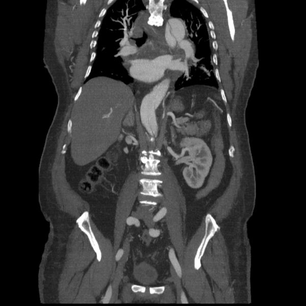 File:Aortic dissection (Radiopaedia 28802-29105 B 21).jpg