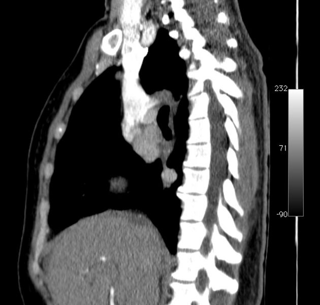 File:Aortic dissection - Stanford type A (Radiopaedia 29247-29659 C 36).jpg