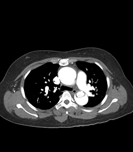 File:Aortic dissection with renal ischemia (Radiopaedia 76573-88338 A 21).jpg