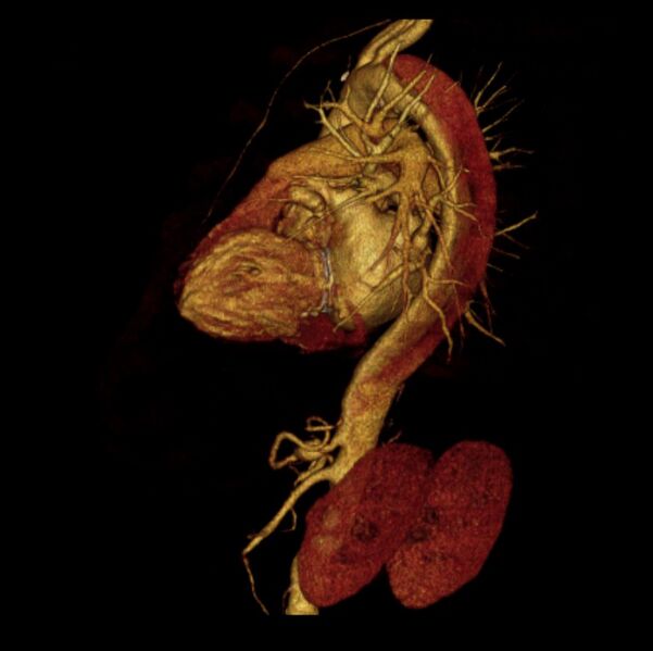 File:Aortic dissection with rupture into pericardium (Radiopaedia 12384-12647 D 26).jpg