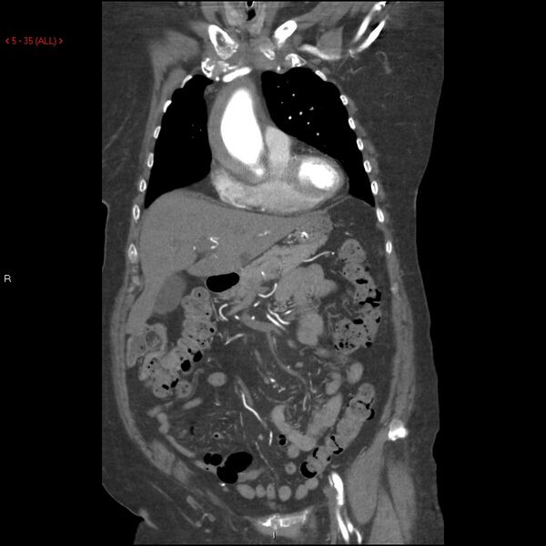 File:Aortic intramural hematoma (Radiopaedia 27746-28001 B 12).jpg