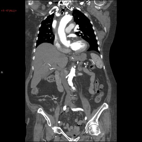 File:Aortic intramural hematoma (Radiopaedia 27746-28001 B 24).jpg