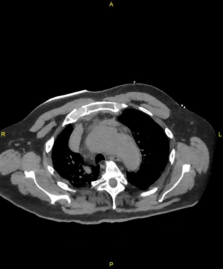 Aortic rupture (Radiopaedia 88822-105594 Axial non-contrast 47).jpg