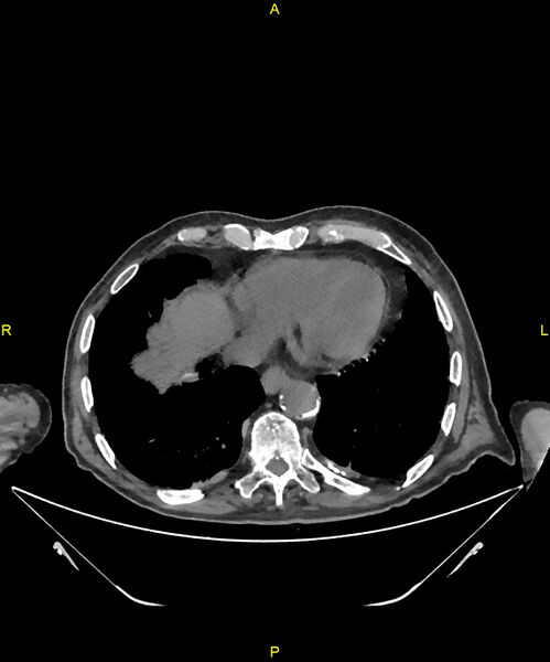 File:Aortoenteric fistula (Radiopaedia 84308-99603 Axial non-contrast 5).jpg
