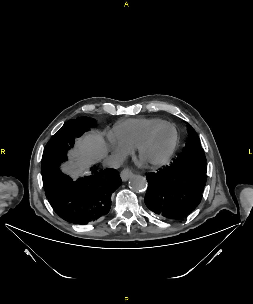 Aortoenteric fistula (Radiopaedia 84308-99603 Axial non-contrast 5).jpg