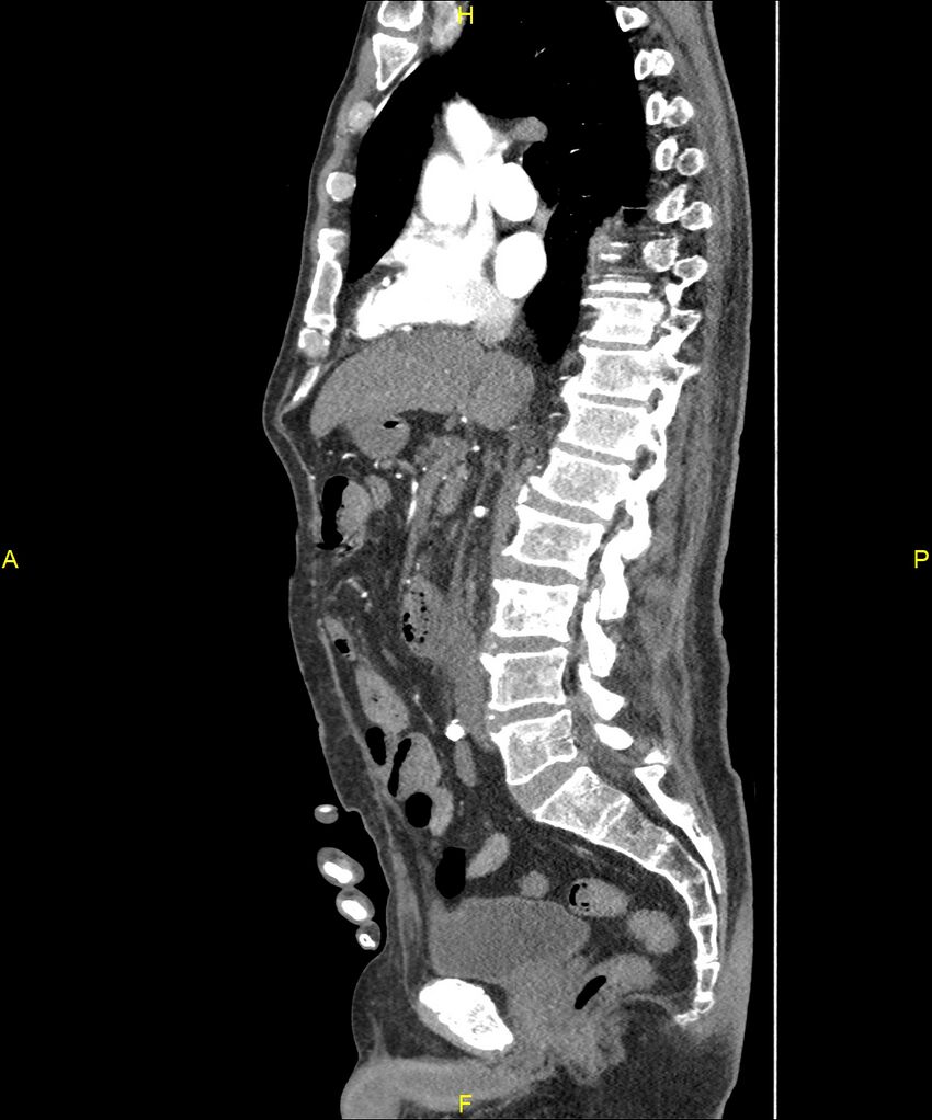 Aortoenteric fistula (Radiopaedia 84308-99603 C 163).jpg
