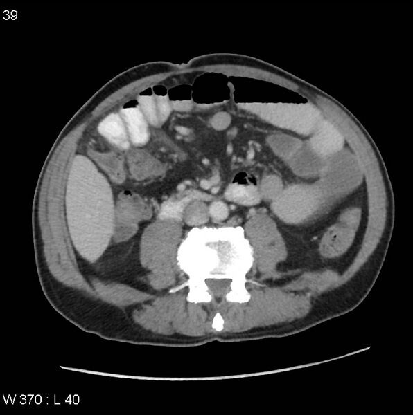 File:Appendicitis (Radiopaedia 27446-27642 A 18).jpg