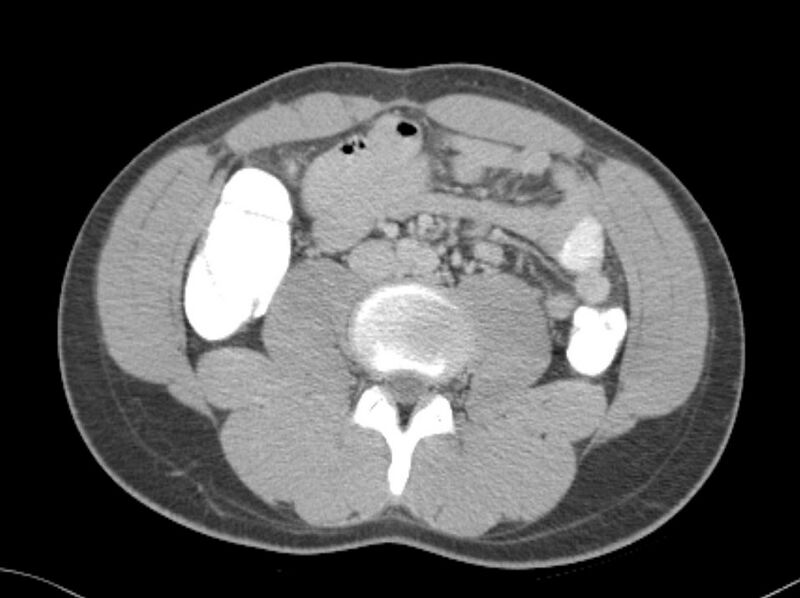 File:Appendicitis and incidental foregut duplication cyst (Radiopaedia 52962-58916 A 40).jpg