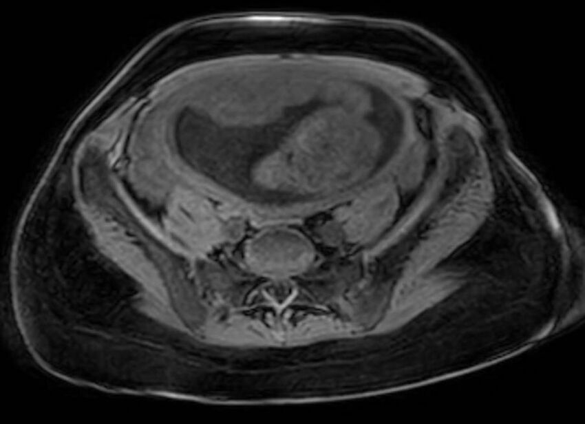 Appendicitis in gravida (MRI) (Radiopaedia 89433-106395 Axial DIXON 104).jpg