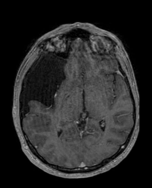 File:Arachnoid cyst- extremely large (Radiopaedia 68741-78451 Axial T1 C+ 39).jpg
