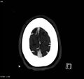 Arteriovenous malformation - cerebral (Radiopaedia 8172-14682 A 16).jpg