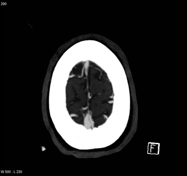 File:Arteriovenous malformation - cerebral (Radiopaedia 8172-14682 A 16).jpg