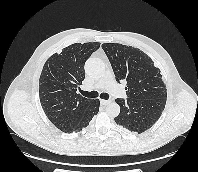 File:Asbestos pleural placques (Radiopaedia 57905-64872 Axial lung window 102).jpg
