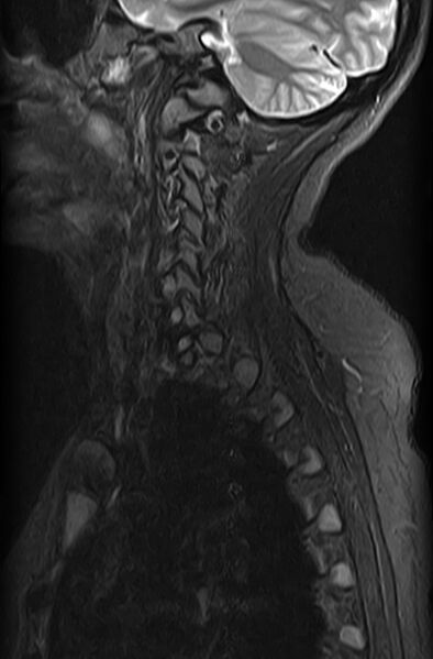 File:Astrocytoma - spinal cord (Radiopaedia 69769-79758 Sagittal STIR 2).jpg