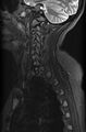 Astrocytoma - spinal cord (Radiopaedia 69769-79758 Sagittal STIR 2).jpg