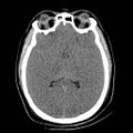 Atlanto-occipital dislocation (Radiopaedia 44648-48412 Axial non-contrast 29).jpg