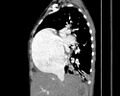 Atrial septal defect complicated by Eisenmenger syndrome (Radiopaedia 53707-59768 Sagittal C+ CTPA 9).jpg