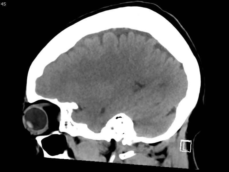 File:Atypical meningioma - intraosseous (Radiopaedia 64915-73867 C 43).jpg