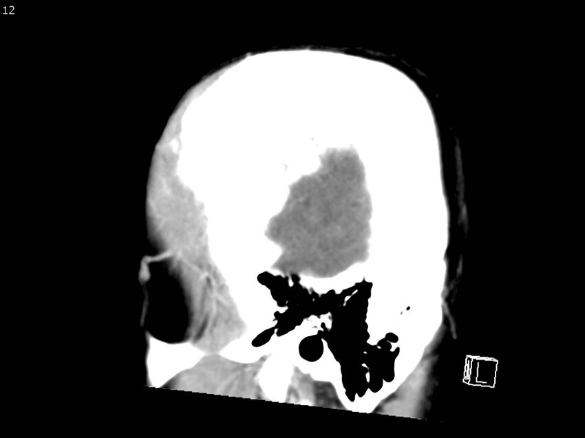 Atypical meningioma - intraosseous (Radiopaedia 64915-73867 F 11).jpg