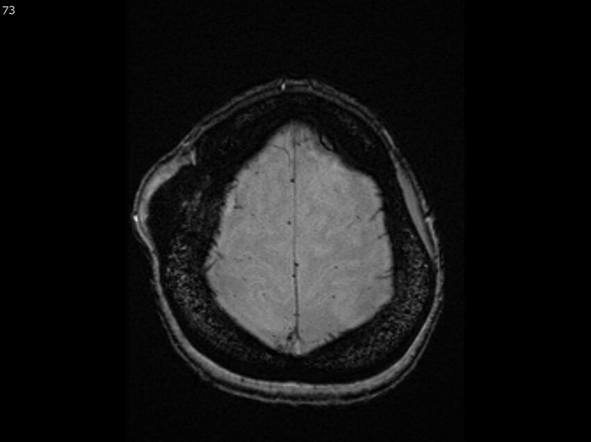 Atypical meningioma - intraosseous (Radiopaedia 64915-74572 Axial SWI 73).jpg